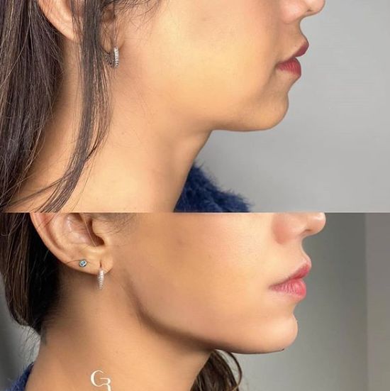Face Lift Face Lift Image